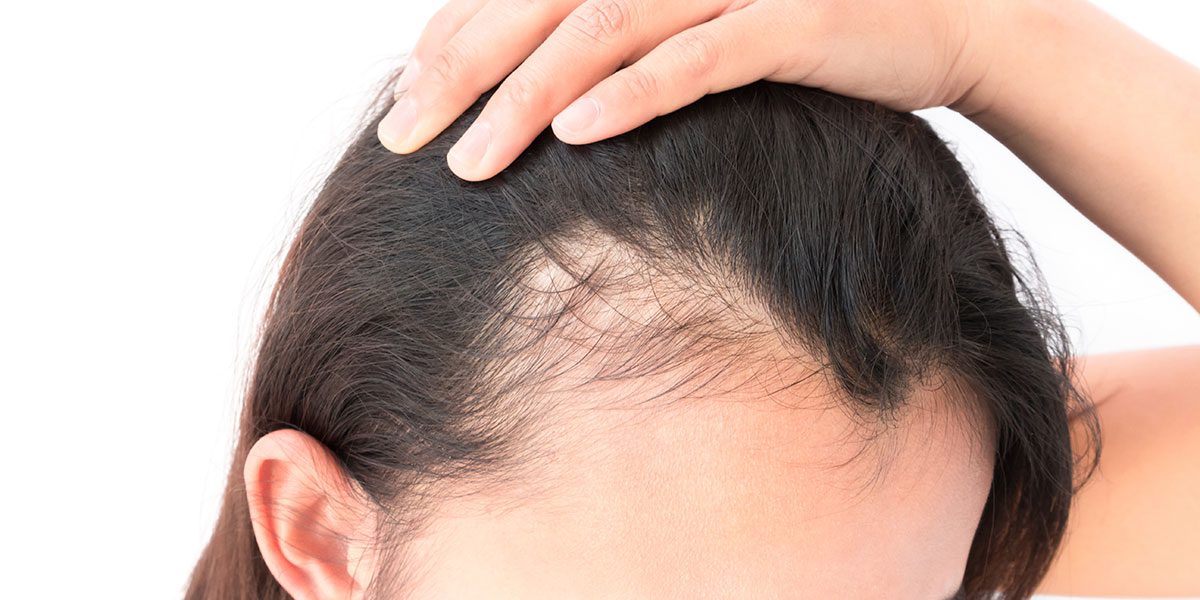 What is Alopecia? Is there a cure? – StimuGro